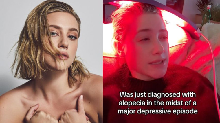 Reinhart was also in the midst of a major depressive episode upon receiving her diagnosis with alopecia. She has previously opened up about her battle with depression in May 2021 via social media.